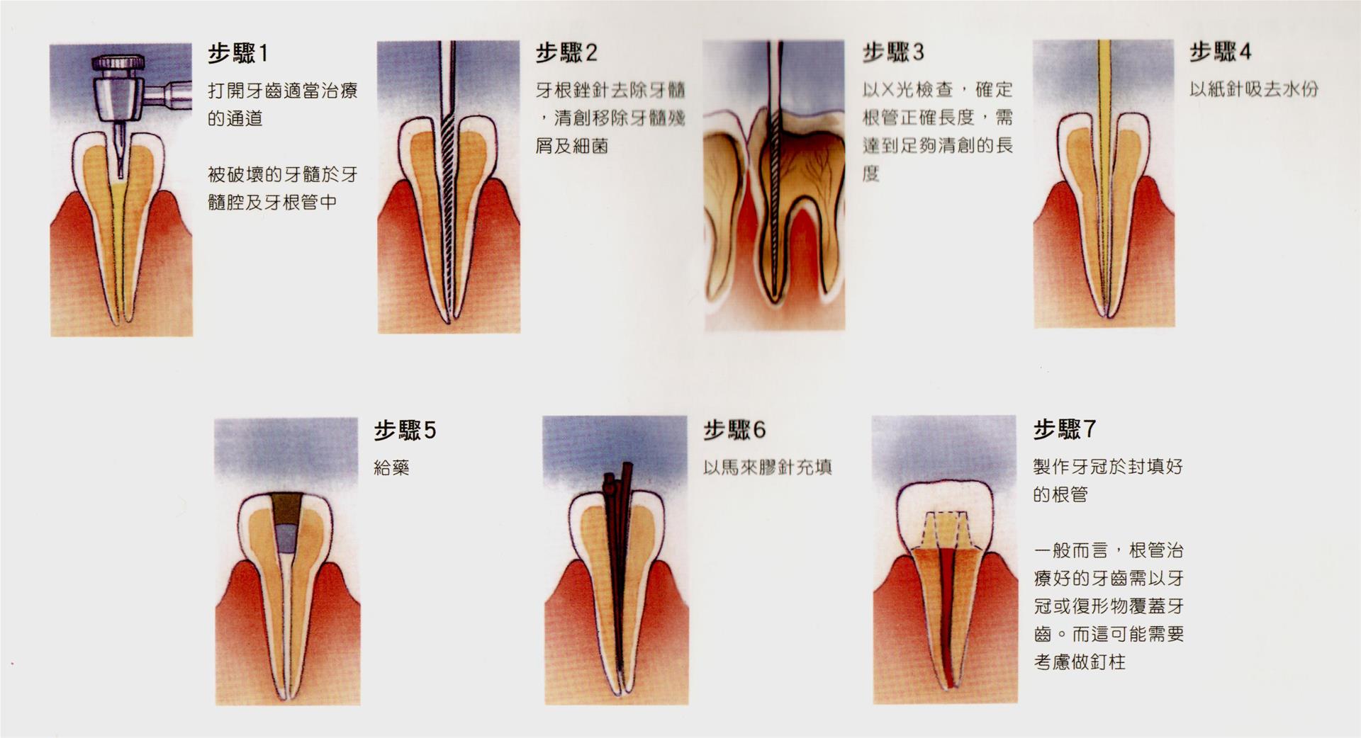 一、显微根管治疗/显微镜下牙体修复-口腔科学-医学